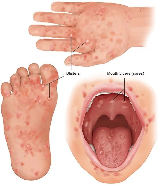 Sơ đồ vị trí xuất hiện các nốt phỏng và vết loét miệng ở trẻ bị tay chân miệng