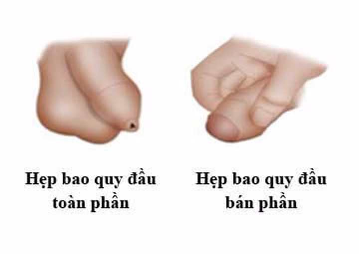 Sơ đồ minh họa bán hẹp bao quy đầu với các mức độ hẹp khác nhau