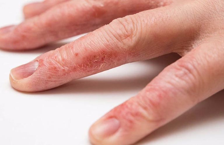 Hình ảnh minh họa tình trạng da tay bị khô, nứt nẻ và bong tróc do bệnh á sừng