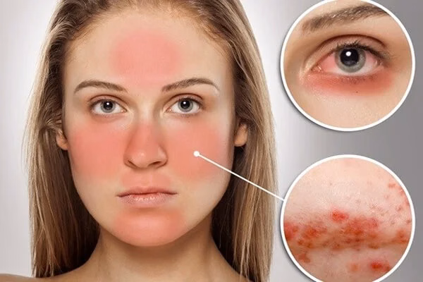 Hình ảnh ban đỏ hình cánh bướm đặc trưng phân bố đối xứng qua sống mũi và hai bên gò má ở người bệnh lupus ban đỏ hệ thống