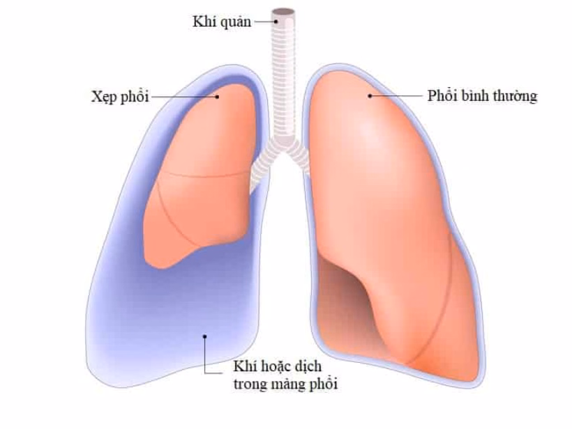 Hình ảnh minh họa cấu trúc nhu mô phổi bình thường và vùng phế nang bị xẹp giảm thể tích