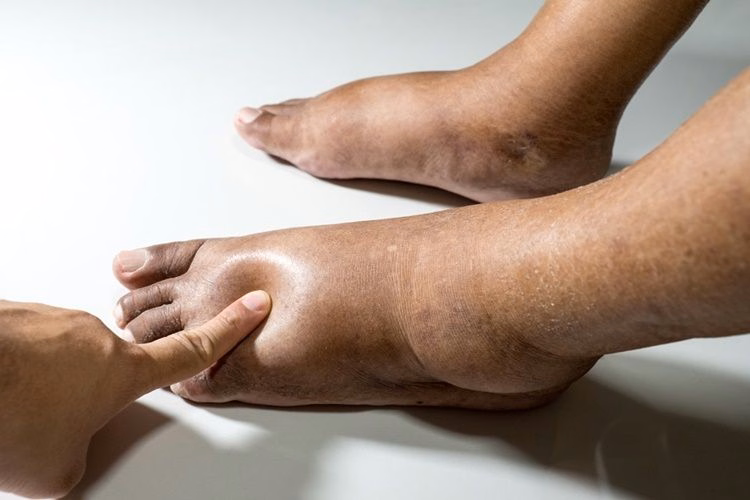 Bác sĩ kiểm tra dấu hiệu ấn lõm trên cẳng chân bị sưng phù của người bệnh