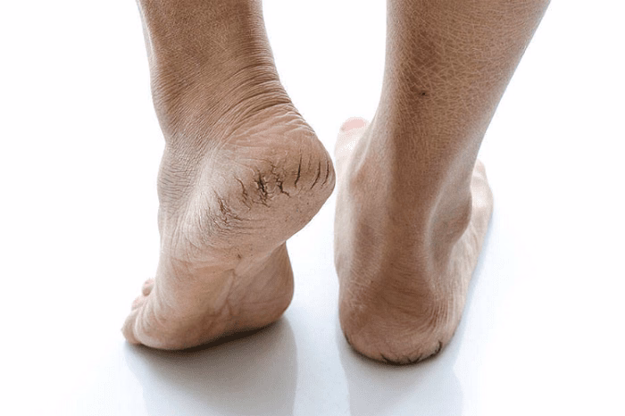 Hình ảnh gót chân bị khô ráp và xuất hiện các vết nứt nẻ ở lớp biểu bì