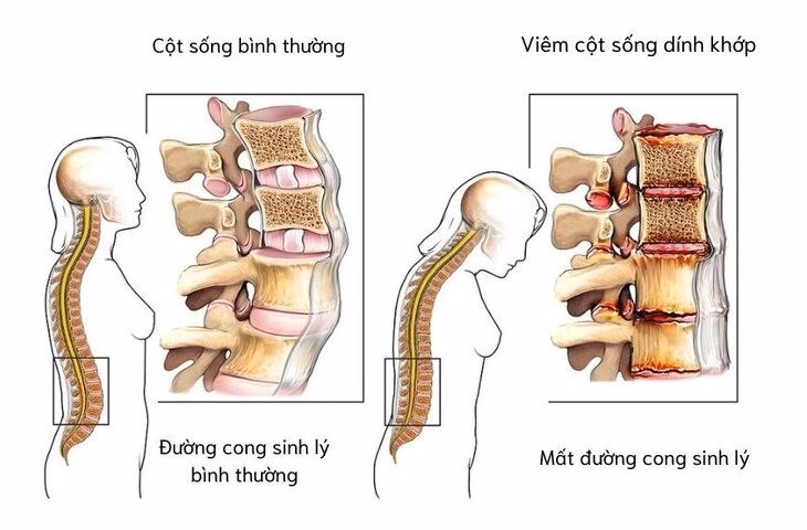 Hình ảnh mô phỏng tổn thương viêm và dính các đốt sống ở bệnh nhân viêm cột sống dính khớp
