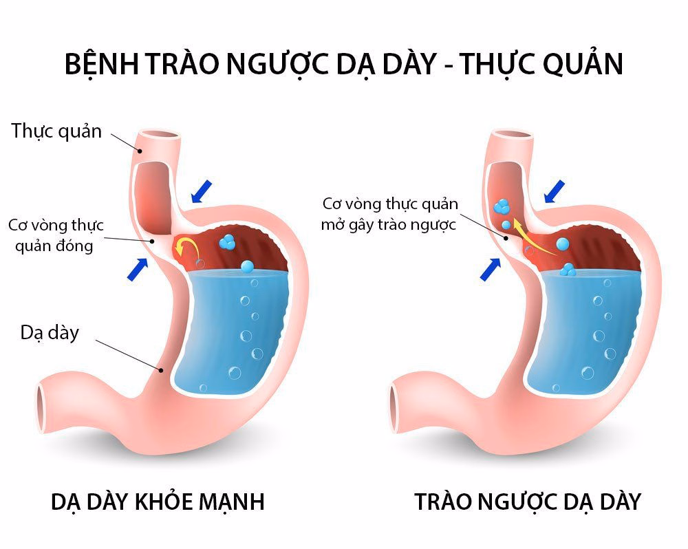 Hình minh họa cảm giác nóng rát sau xương ức do acid dạ dày trào ngược lên thực quản gây ợ chua