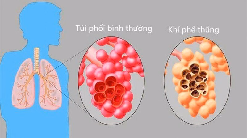 Hình ảnh mô phỏng cấu trúc túi phế nang bình thường so với phế nang bị phá hủy và giãn rộng trong bệnh khí phế thũng
