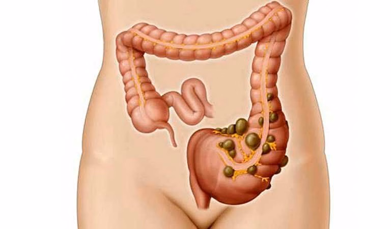 Hình ảnh giải phẫu vị trí các túi thừa và cấu trúc thành đại tràng bị sưng viêm
