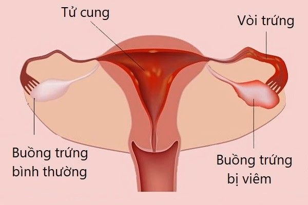 Hình ảnh minh họa giải phẫu vị trí buồng trứng và vòi trứng trong khung chậu nữ giới
