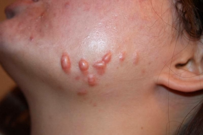 Hình ảnh tổn thương sẹo lồi màu hồng đỏ gồ cao trên bề mặt da vùng ngực