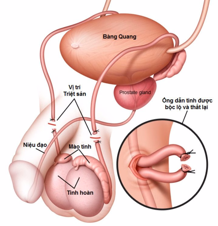 Hình ảnh minh họa vị trí ống dẫn tinh và quá trình cắt nối triệt sản nam an toàn