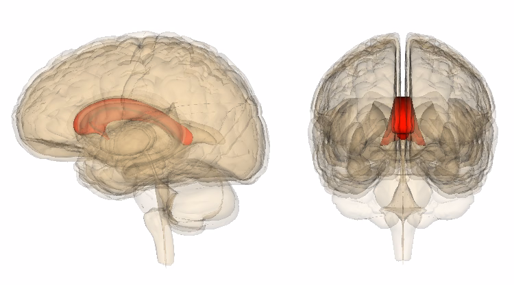 Hình ảnh mô phỏng tổn thương thoái hóa và mất myelin ở vùng thể chai trong bệnh Marchiafava-Bignami