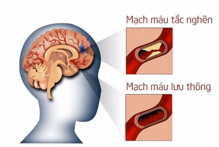 Sơ đồ minh họa cơ chế mạch máu não bị tắc nghẽn tạm thời do mảng xơ vữa hoặc cục máu đông trong cơn thiếu máu não cục bộ thoáng qua TIA