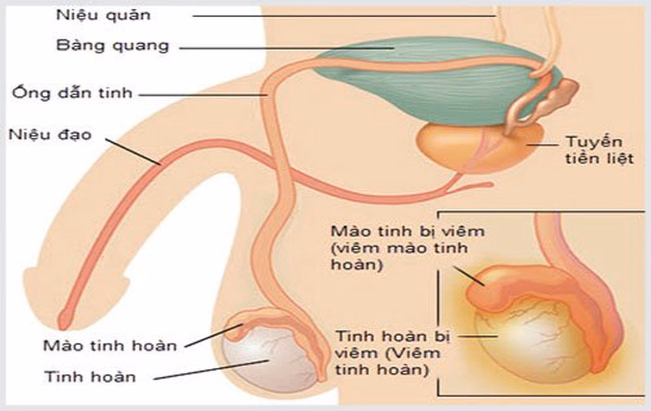 Hình ảnh minh họa cấu trúc tinh hoàn bình thường và tinh hoàn bị viêm sưng to