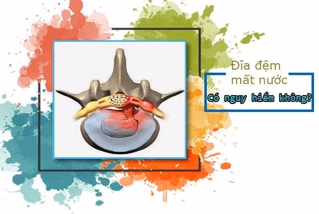 Mô hình giải phẫu đĩa đệm cột sống bị xẹp và thoái hóa chèn ép rễ thần kinh