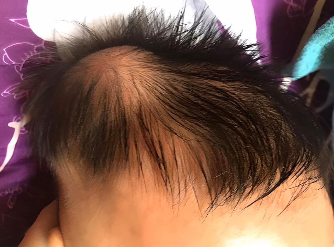 Vùng da đầu trẻ sơ sinh bị sưng nề và rụng tóc khu trú do áp lực trong quá trình chuyển dạ