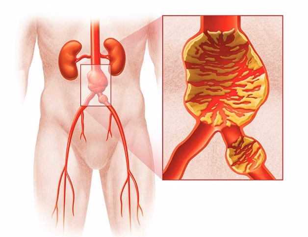 Hình ảnh giải phẫu mô tả cấu trúc phình động mạch tạng trong ổ bụng