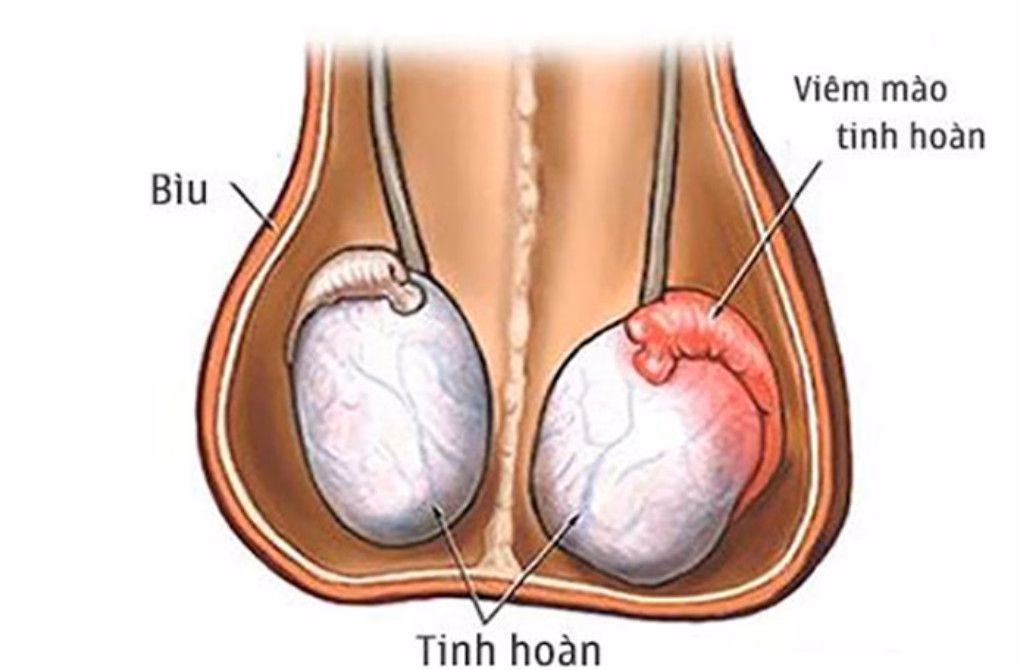 Cấu tạo giải phẫu mào tinh hoàn và biểu hiện sưng đỏ ở vùng bìu nam giới