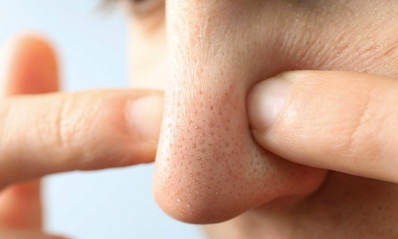 Cận cảnh tổn thương mụn đầu đen tại vùng cánh mũi với các nốt sẫm màu do bã nhờn bị oxy hóa