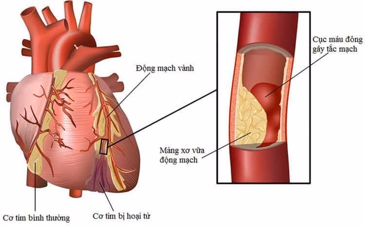 Mô hình mảng xơ vữa tích tụ bên trong lòng động mạch vành làm hẹp dòng máu nuôi cơ tim