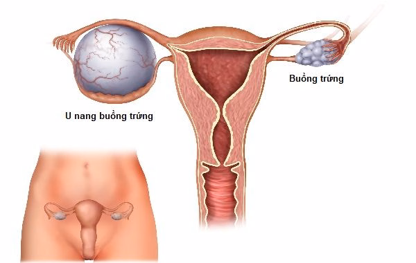 Hình ảnh mô phỏng vị trí và cấu trúc khối u nang trên bề mặt buồng trứng của người phụ nữ