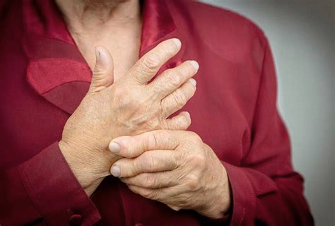 Hình ảnh minh họa tình trạng viêm màng hoạt dịch và tổn thương sưng đau ở các khớp bàn ngón tay do viêm khớp dạng thấp
