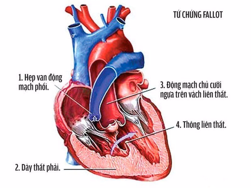 Mô hình cấu trúc giải phẫu tim bẩm sinh và các bất thường về vách tim buồng tim