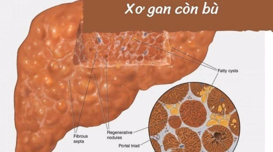 Cấu trúc gan bị tổn thương xơ hóa và hình thành các mô sẹo trong bệnh xơ gan còn bù