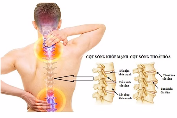 Minh họa giải phẫu đốt sống và đĩa đệm chịu ảnh hưởng bởi thoái hóa cột sống