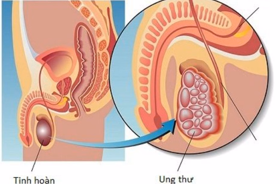 Hình ảnh minh họa cấu trúc giải phẫu tinh hoàn và vị trí phát sinh khối u ở nam giới