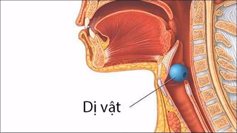 Bác sĩ chuyên khoa thực hiện thủ thuật nội soi gắp dị vật đường thở cho người bệnh tại bệnh viện