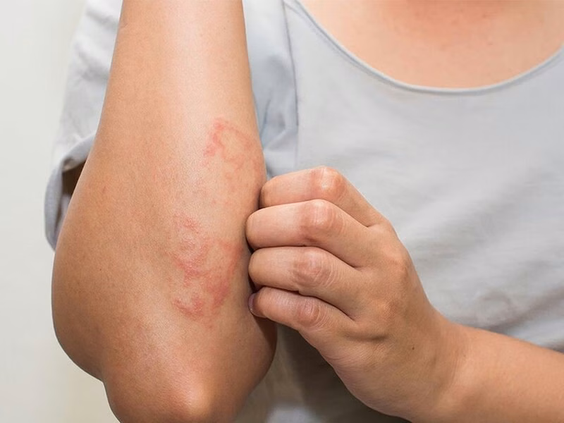 Hình ảnh tổn thương da nổi mẩn đỏ mụn nước và bong tróc vảy do bệnh viêm da
