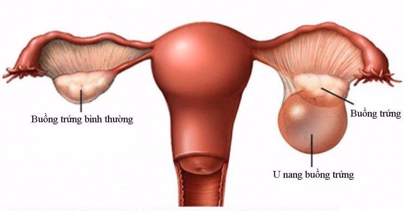 Hình ảnh siêu âm minh họa khối u bì buồng trứng với cấu trúc tăng âm không đồng nhất