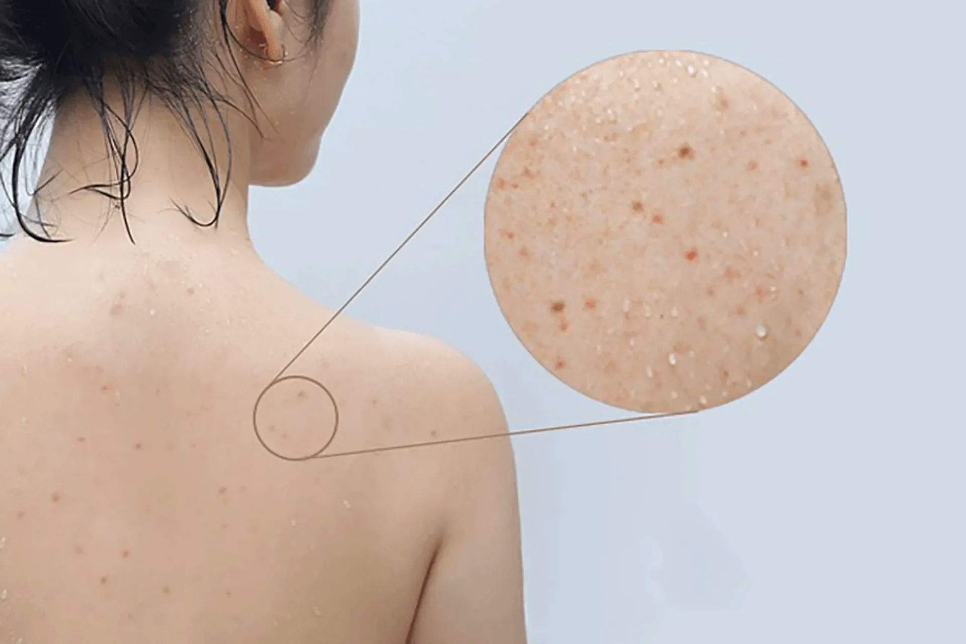 Hình ảnh minh họa các tổn thương mụn trứng cá thường gặp ở vùng lưng và vai