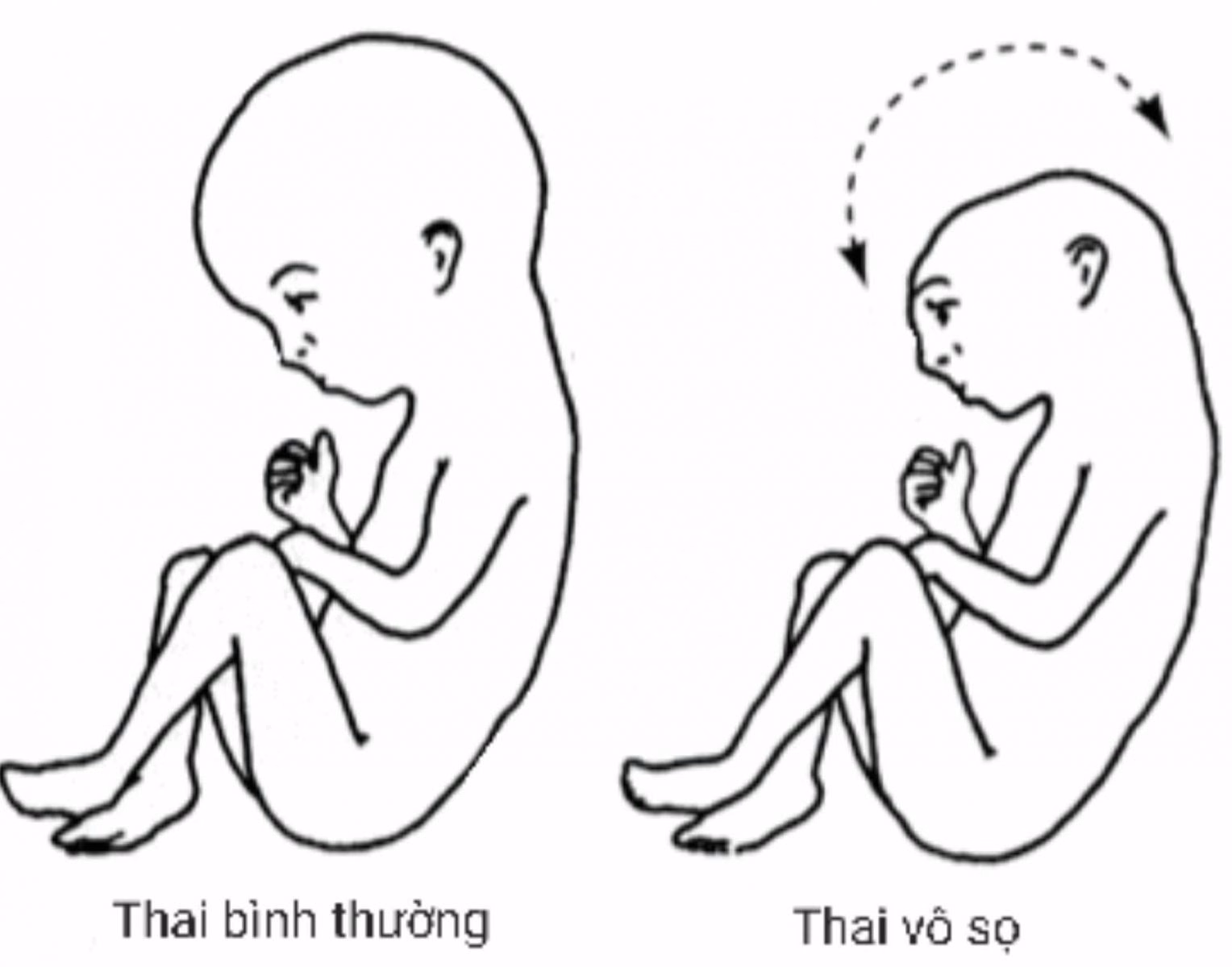 Hình ảnh siêu âm thai kỳ giúp phát hiện sớm dị tật thiếu một phần não và bất thường xương vòm sọ