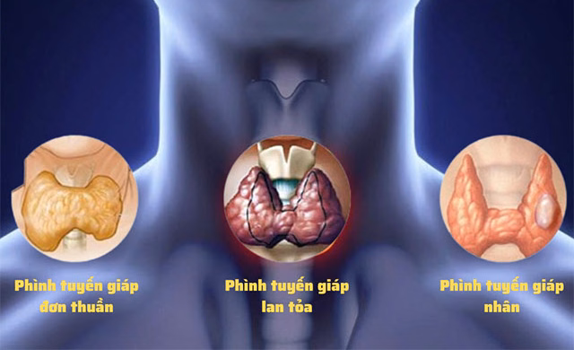 Sơ đồ minh họa vị trí giải phẫu tuyến giáp ở vùng cổ trước và tình trạng phì đại trong bướu giáp đơn thuần