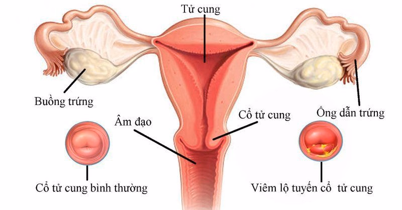 Hình ảnh minh họa cấu trúc giải phẫu cổ tử cung và vị trí các tế bào biểu mô trụ phát triển lộ tuyến