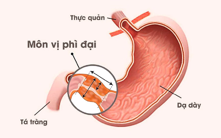 Hình ảnh mô phỏng tình trạng phì đại cơ môn vị gây tắc nghẽn đường ra của dạ dày ở trẻ nhỏ