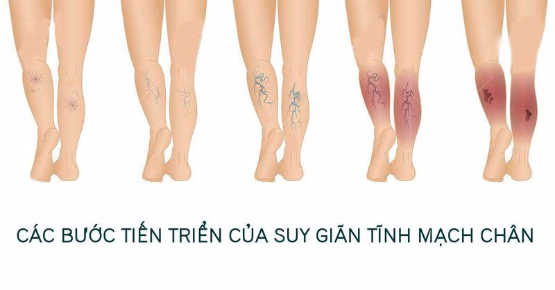Sơ đồ minh họa các giai đoạn tiến triển của suy giãn tĩnh mạch chi dưới từ giãn mao mạch đến loét da chân