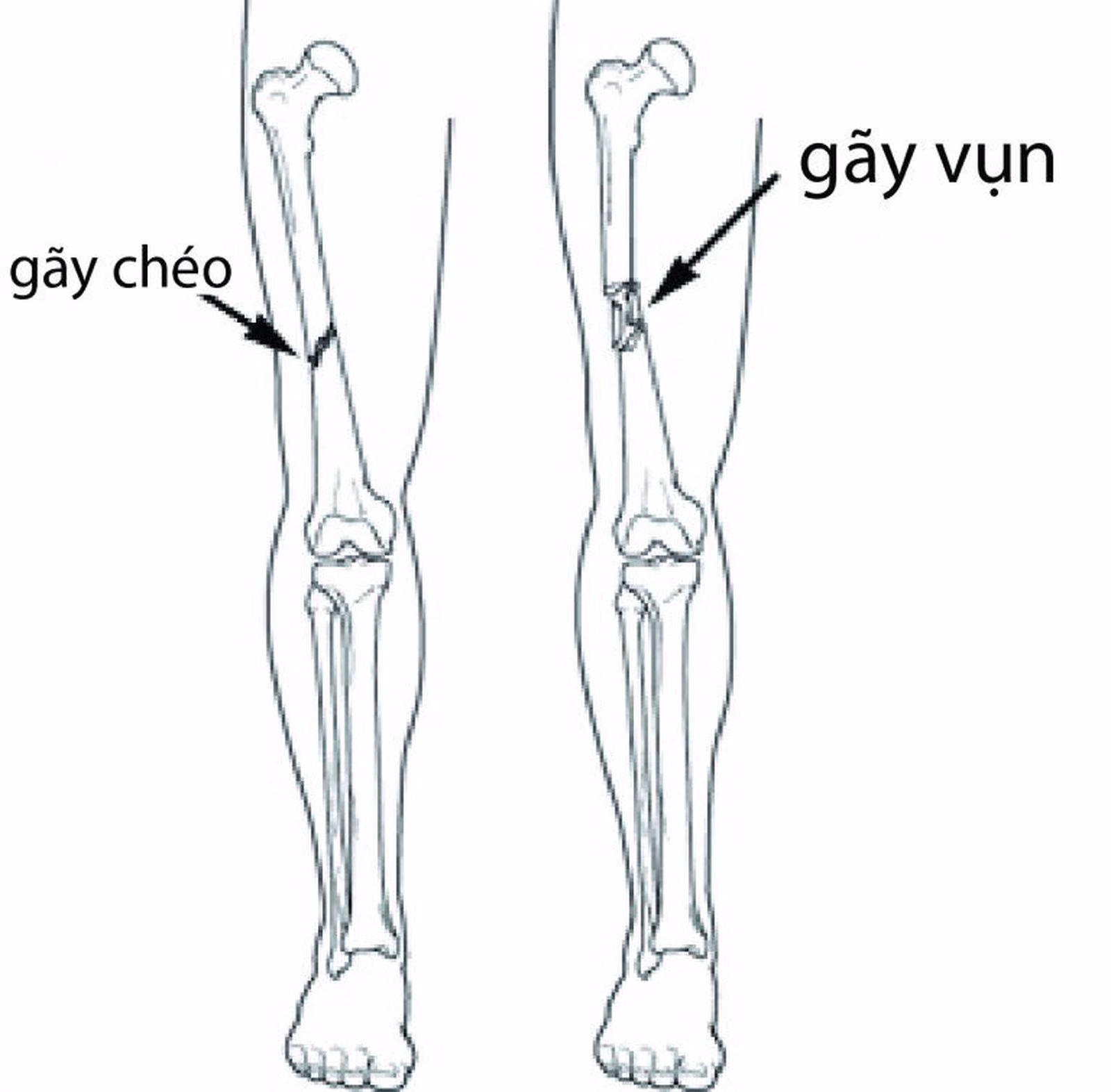 Hình ảnh mô phỏng tổn thương gãy xương và cấu trúc xương bị gián đoạn