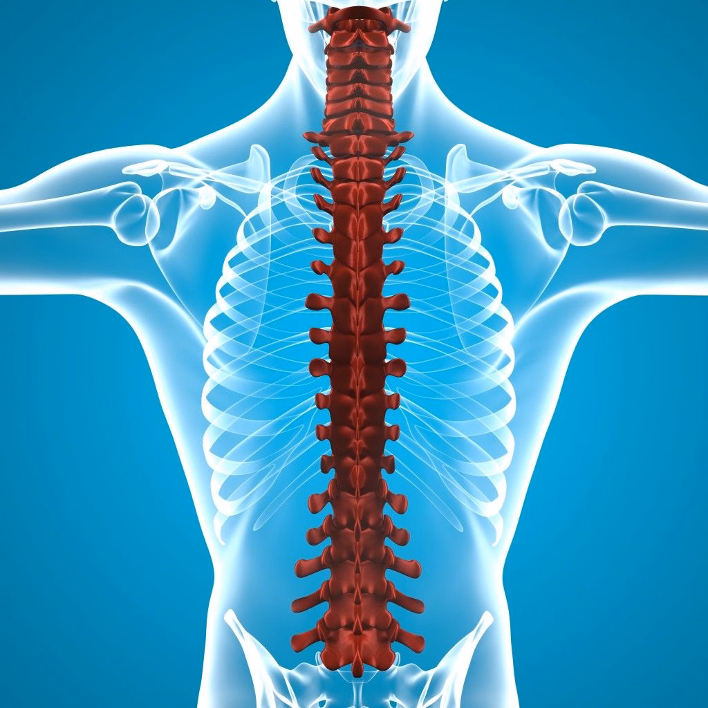 Hình ảnh minh họa vị trí khối u tủy sống gây chèn ép lên tủy gai và rễ thần kinh