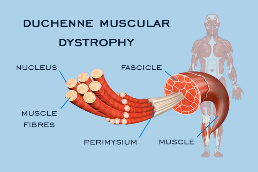 Bé trai biểu hiện dấu hiệu đứng dậy khó khăn do yếu cơ gốc chi trong bệnh loạn dưỡng cơ Duchenne