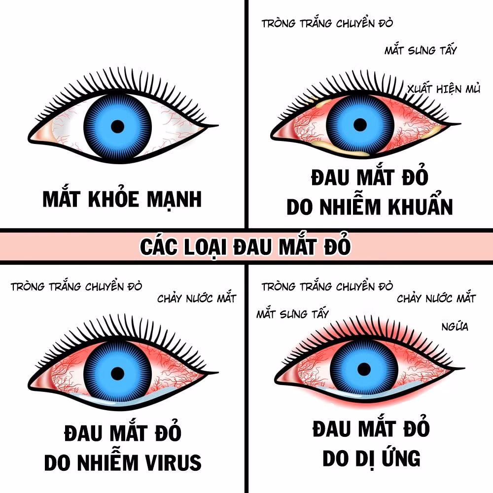 Hình minh họa so sánh mắt khỏe mạnh và ba thể đau mắt đỏ do vi khuẩn, virus và dị ứng