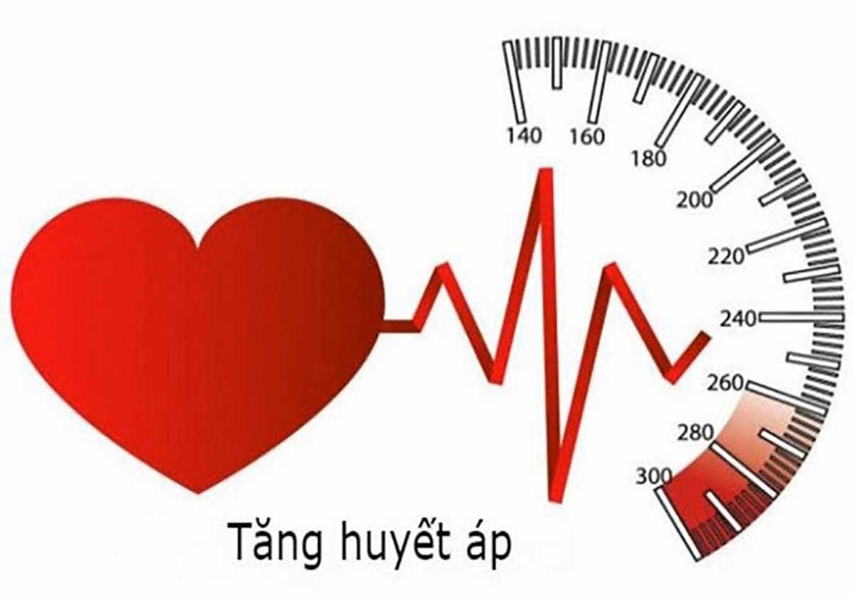 Hình ảnh minh họa vị trí và cấu trúc phình động mạch gan ngoài gan