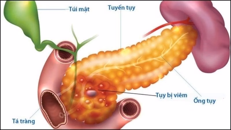 Hình ảnh minh họa vị trí tổn thương tuyến tụy trong bệnh lý viêm tụy mạn tính tái phát