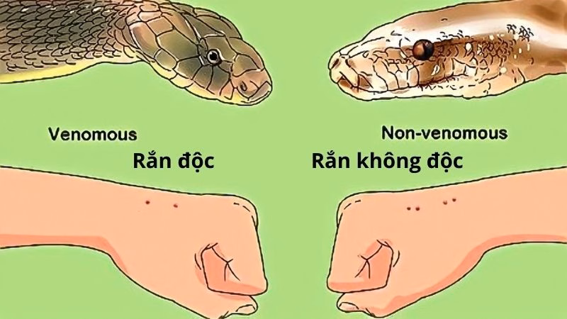 Hình ảnh nhận biết hai vết răng nanh đặc trưng của vết rắn độc cắn kèm hiện tượng sưng nề bầm tím xung quanh da