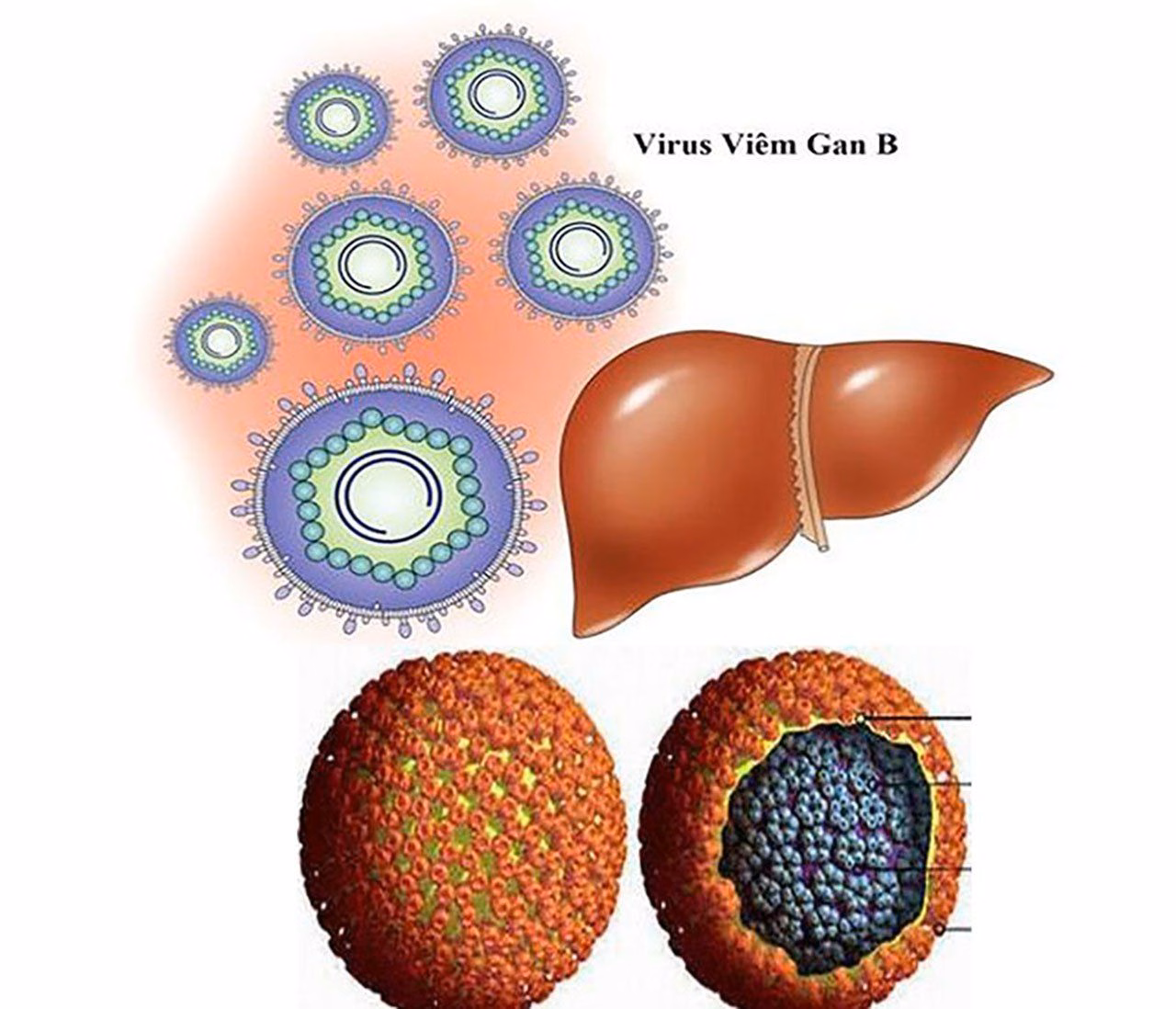 Minh họa cấu trúc hạt virus viêm gan D phụ thuộc lớp vỏ kháng nguyên bề mặt của virus viêm gan B