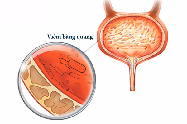 Cấu trúc giải phẫu bàng quang và đường tiết niệu bị viêm nhiễm do vi khuẩn xâm nhập