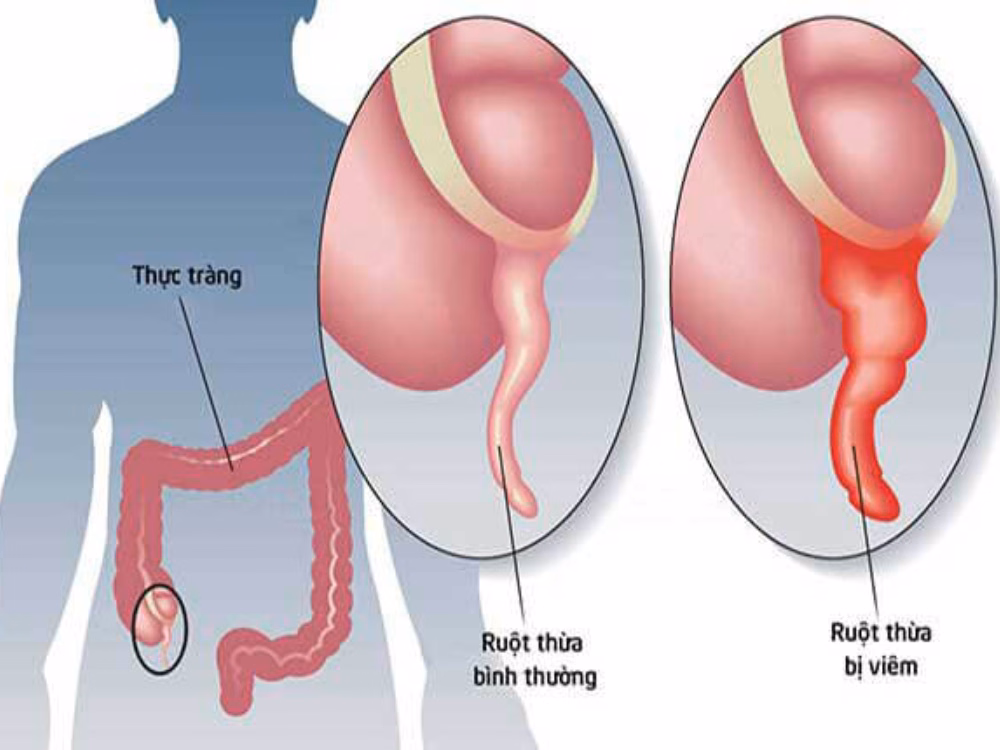 Hình minh họa vị trí giải phẫu của ruột thừa ở đáy manh tràng vùng hố chậu phải