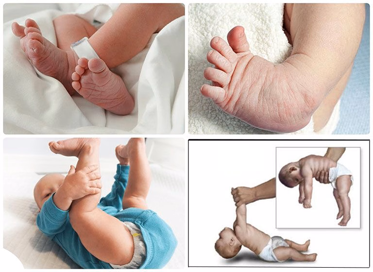 Hình ảnh mô phỏng tình trạng co rút khớp và hạn chế vận động chi ở trẻ sơ sinh mắc chứng cứng đa khớp bẩm sinh