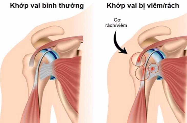 Minh họa cấu trúc giải phẫu khớp vai và tổn thương thoái hóa bào mòn sụn khớp